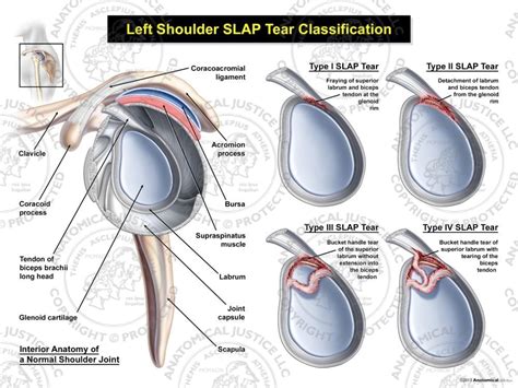 SLAP Lesion / Superior Labrum Tear 